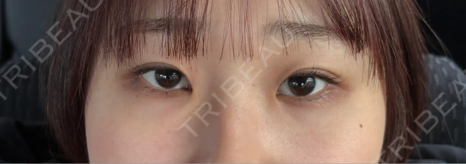 施術前の写真