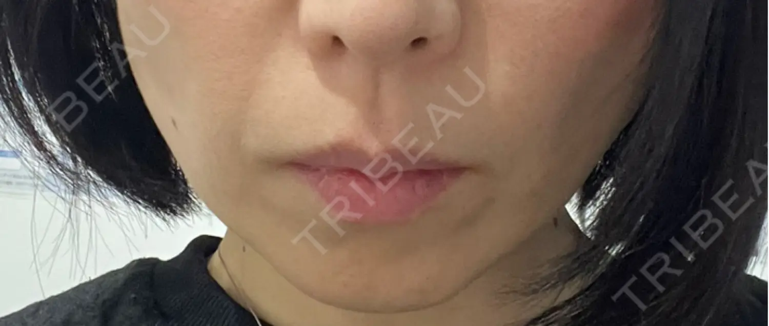 施術前の写真