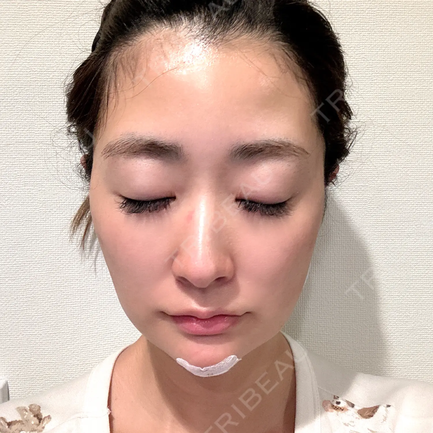 施術前の写真
