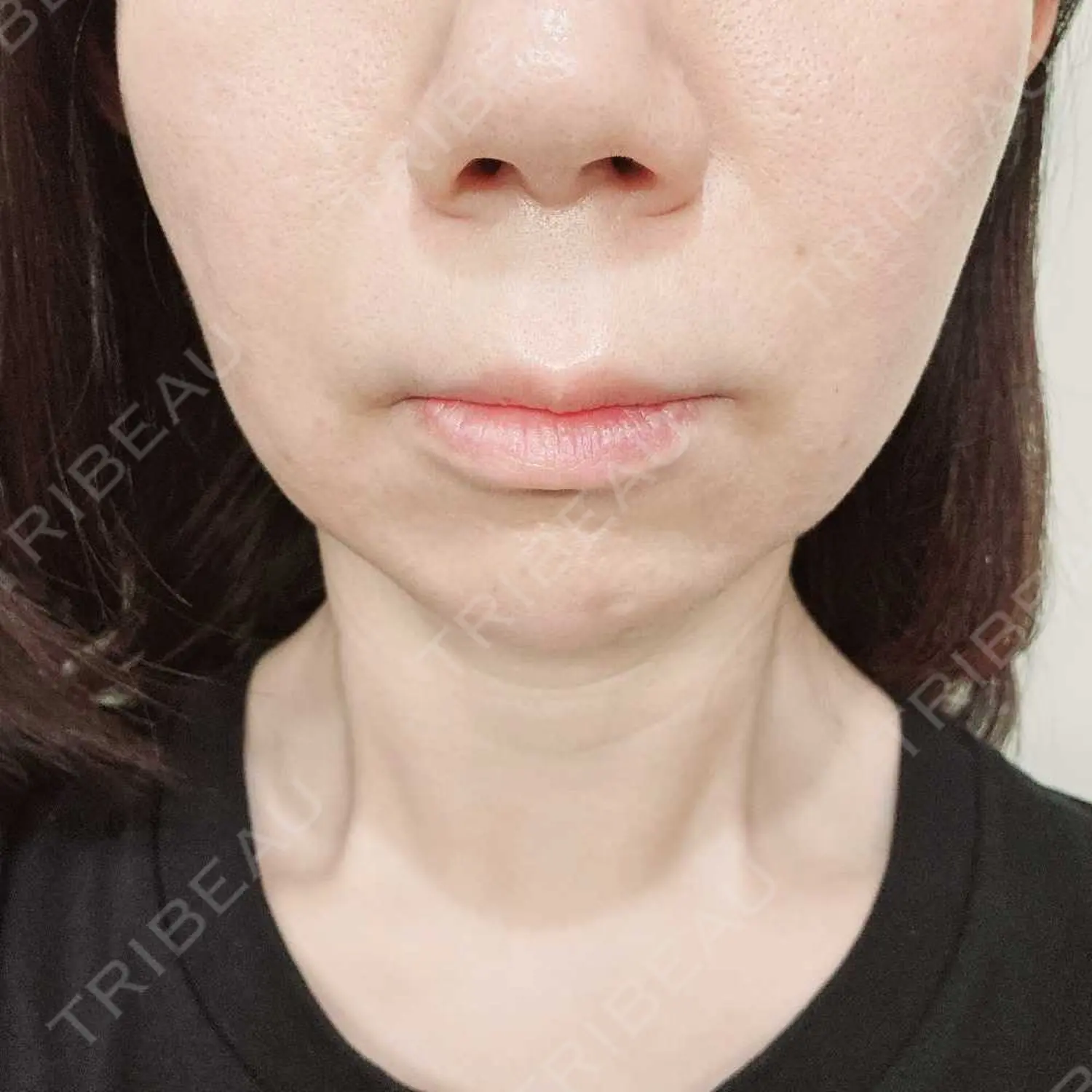 施術前の写真