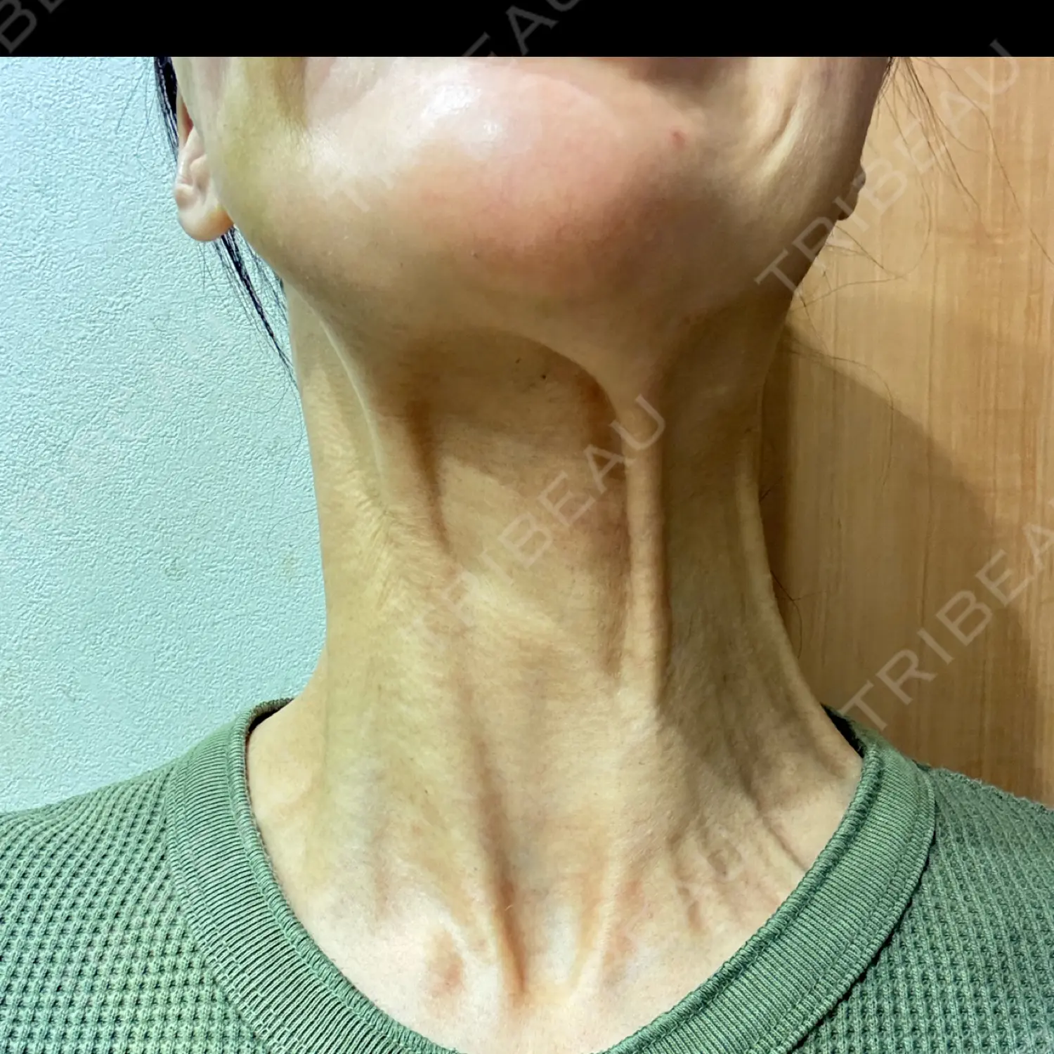 施術前の写真