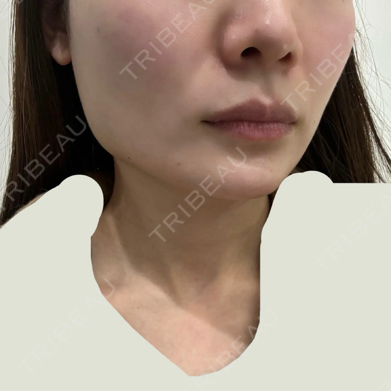 施術前の写真