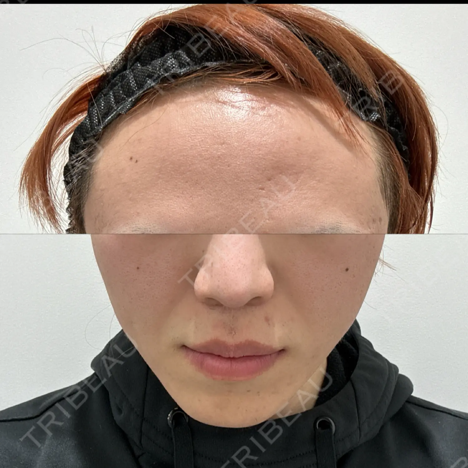 施術前の写真