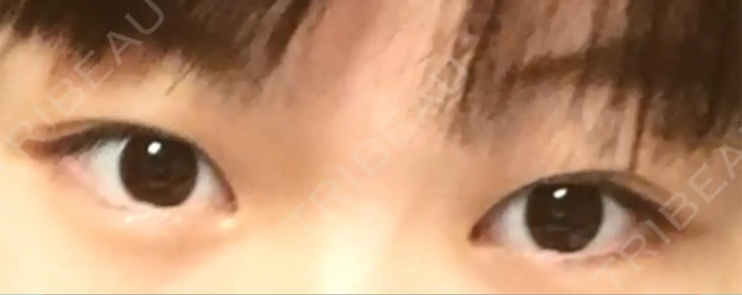 施術前の写真