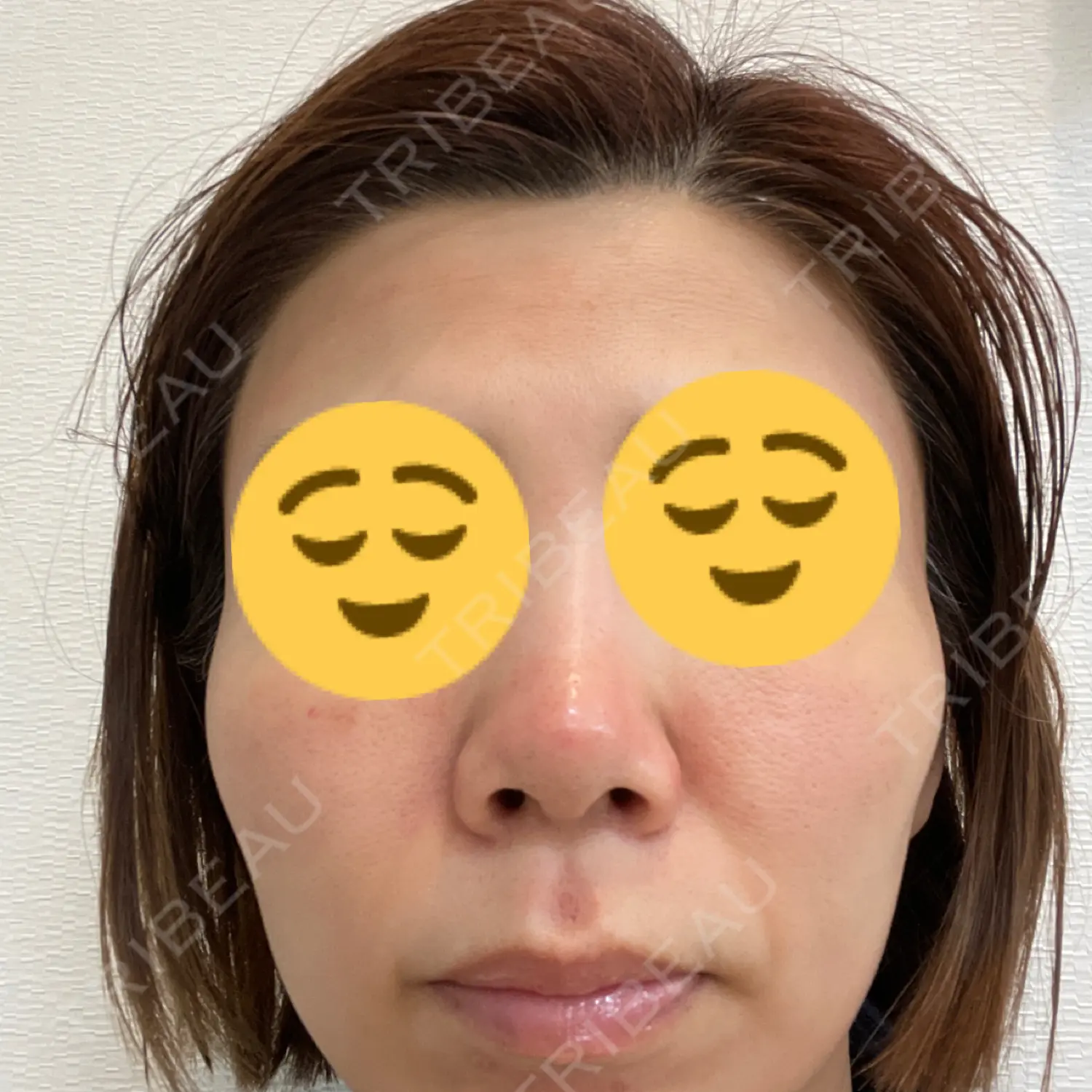 施術前の写真