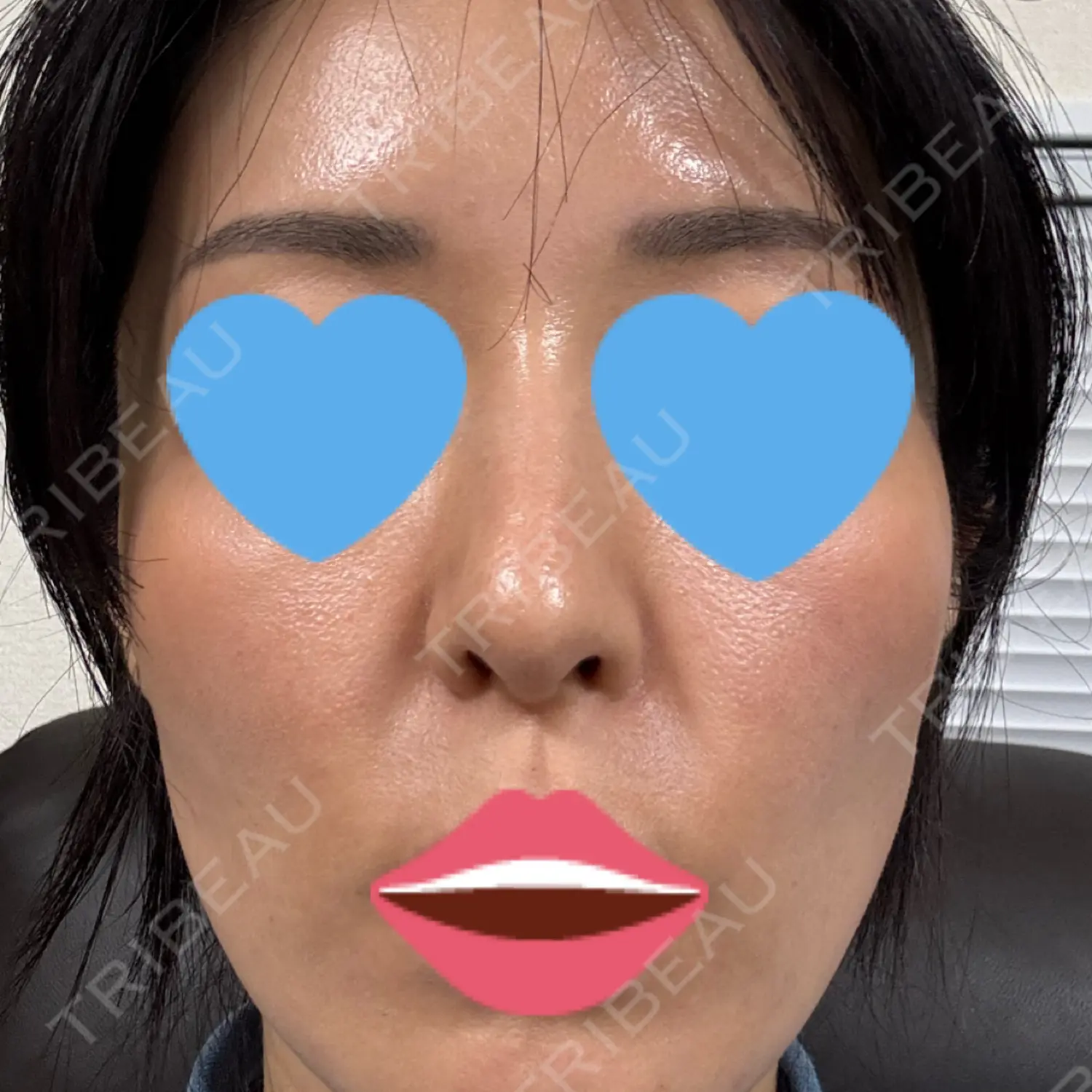 施術前の写真