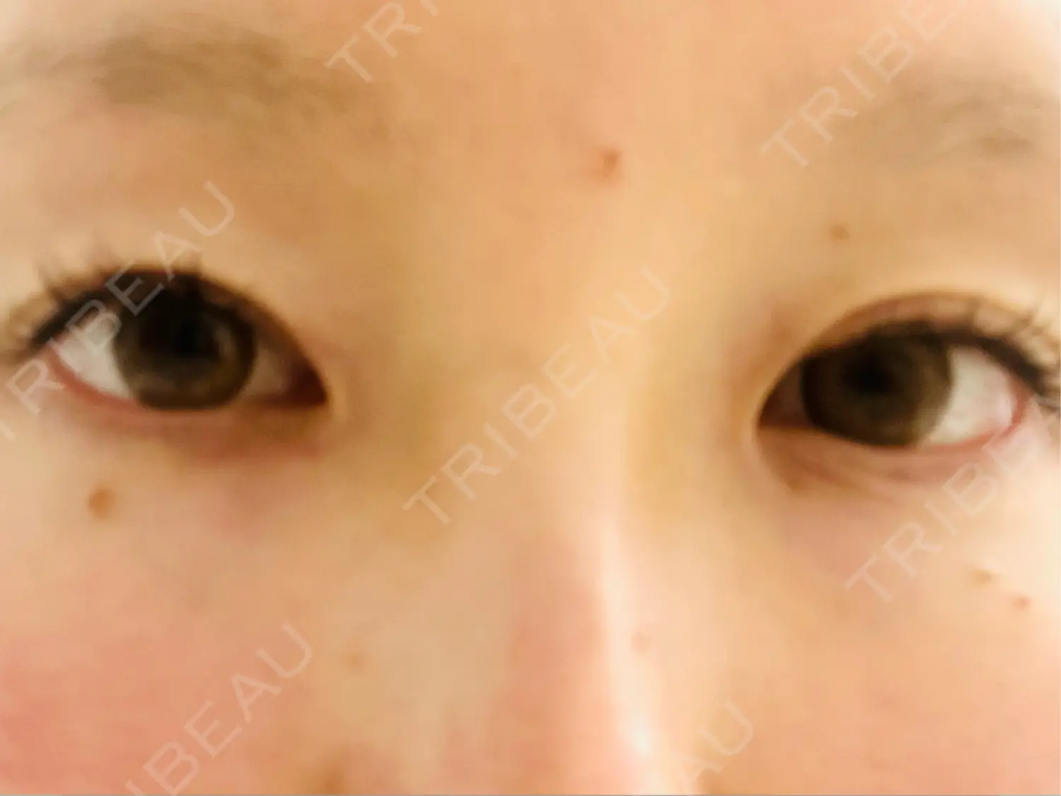 施術前の写真