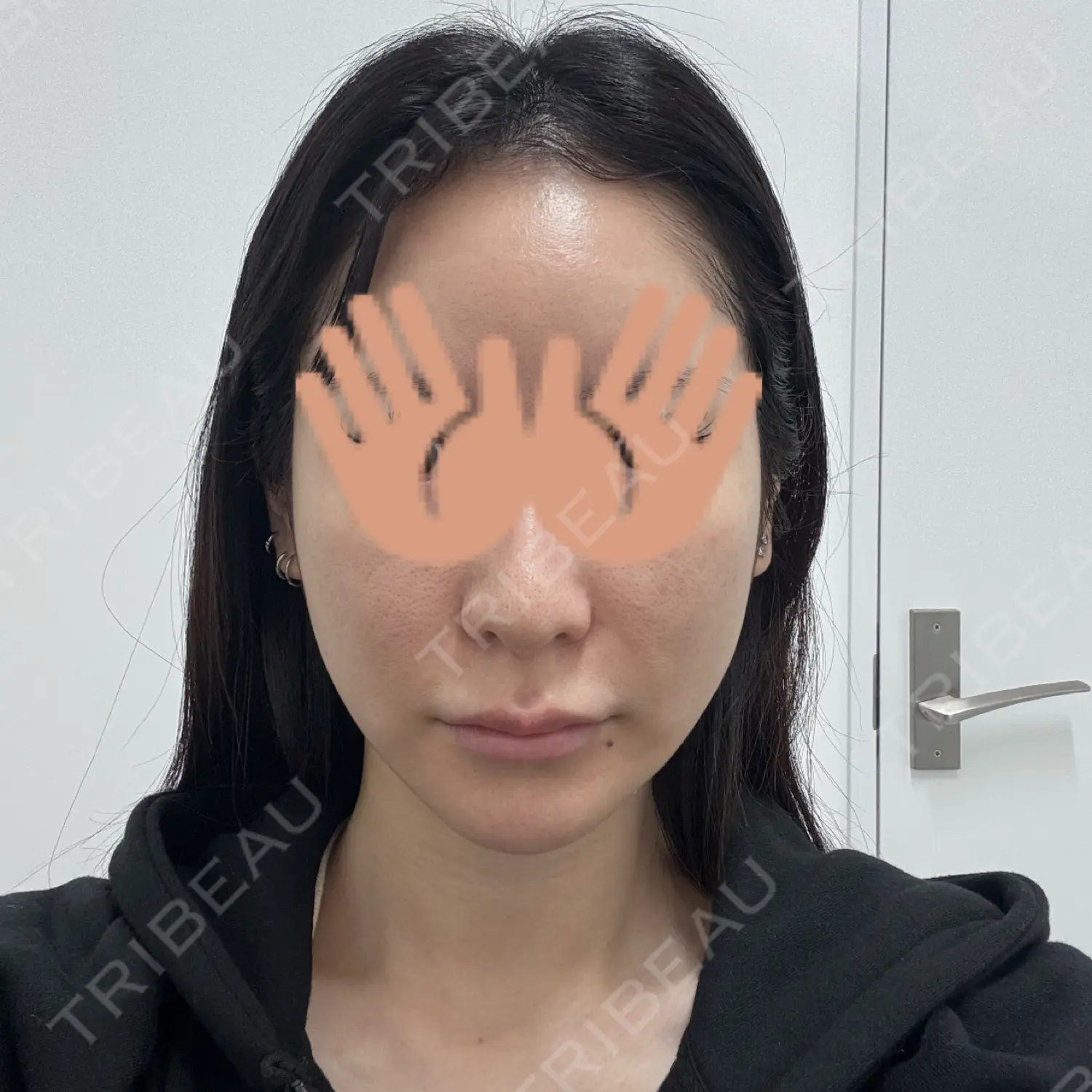 施術前の写真