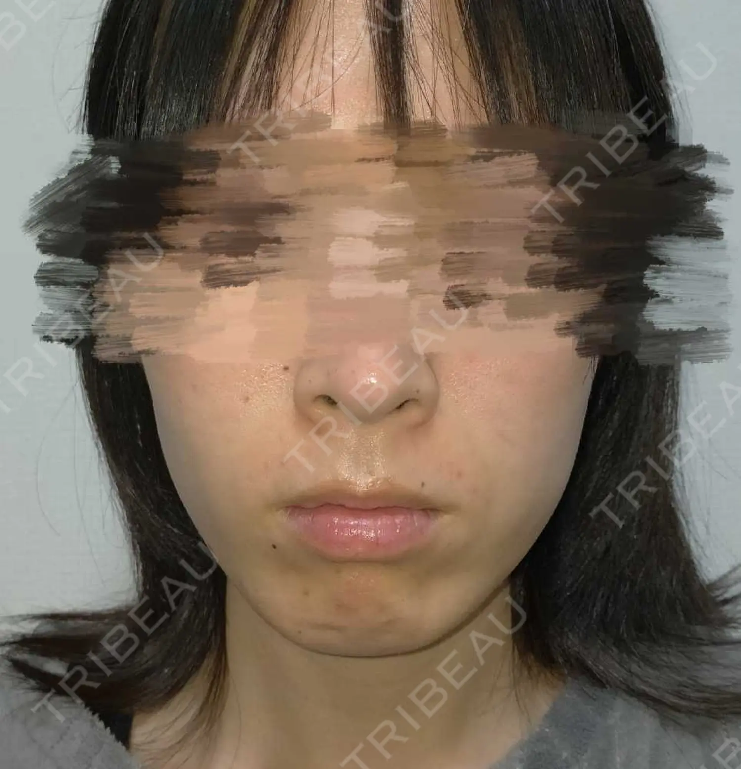 施術前の写真