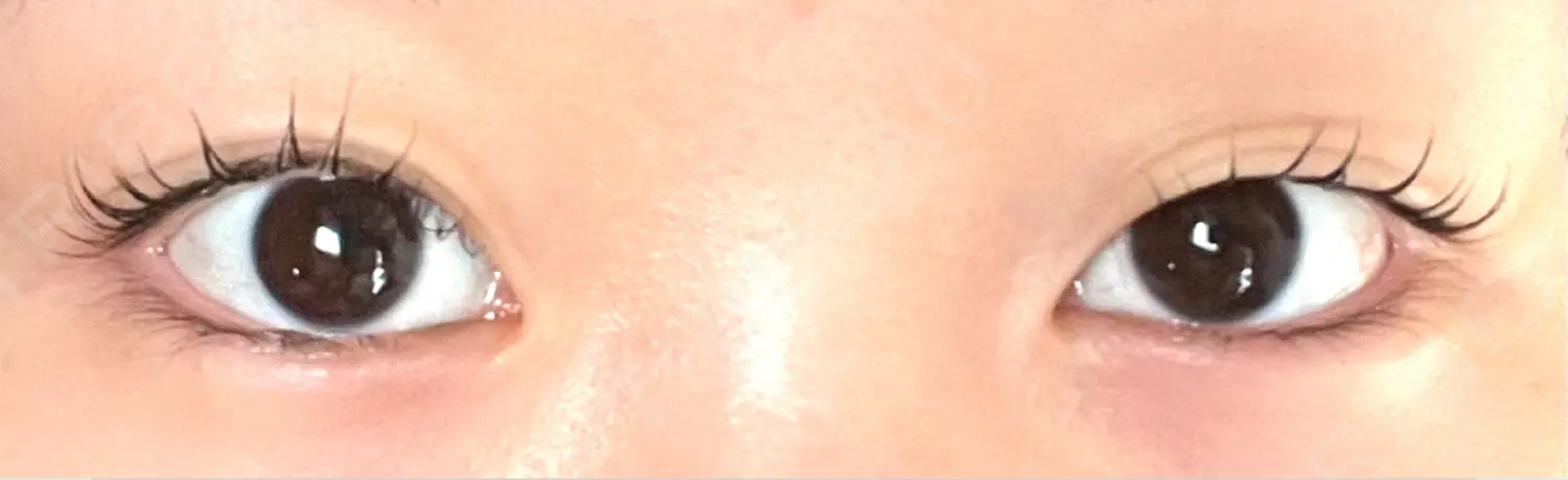 施術前の写真