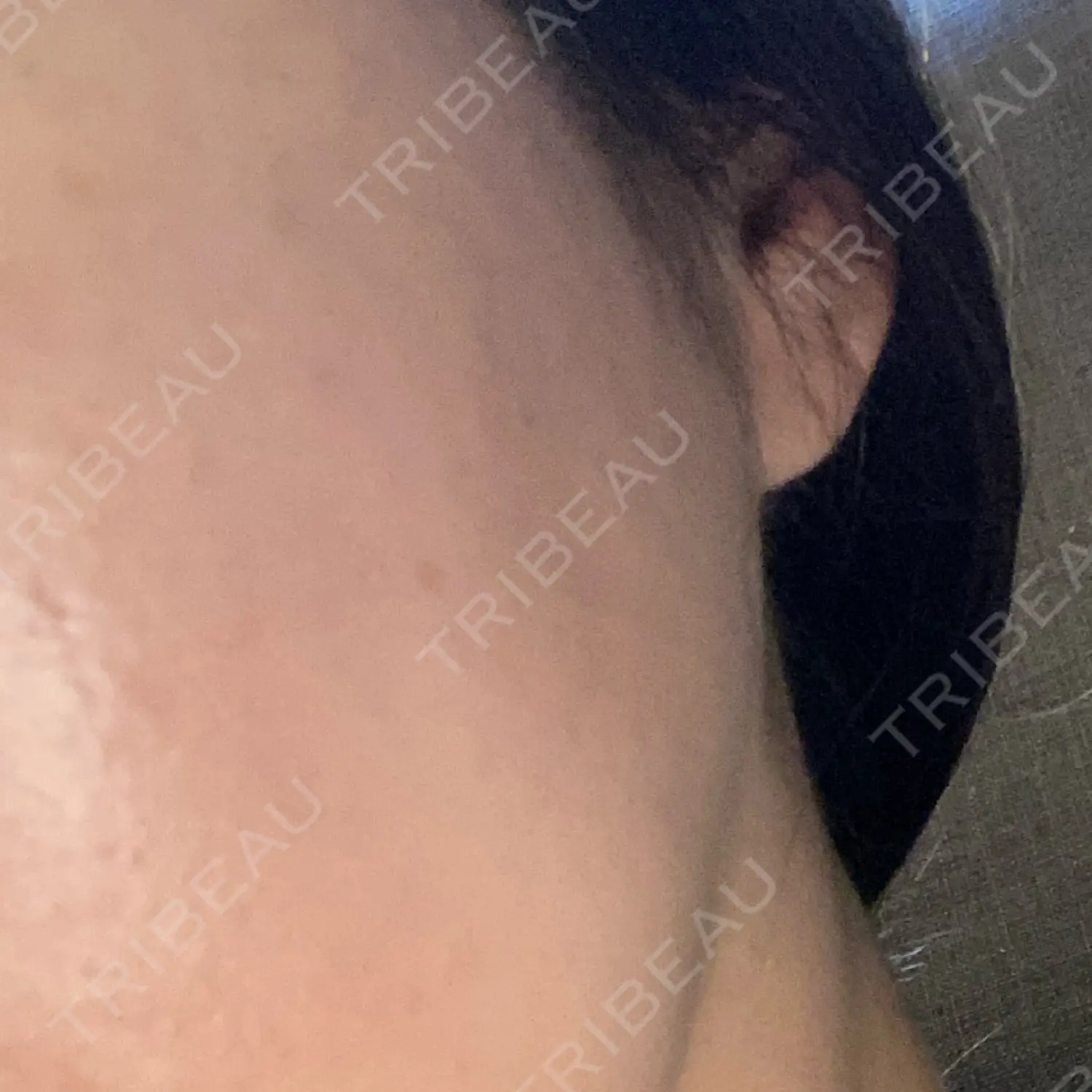 施術前の写真