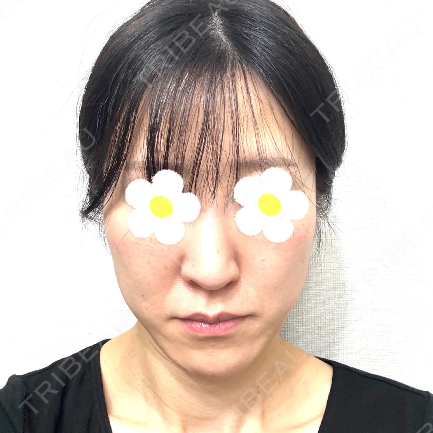 施術前の写真