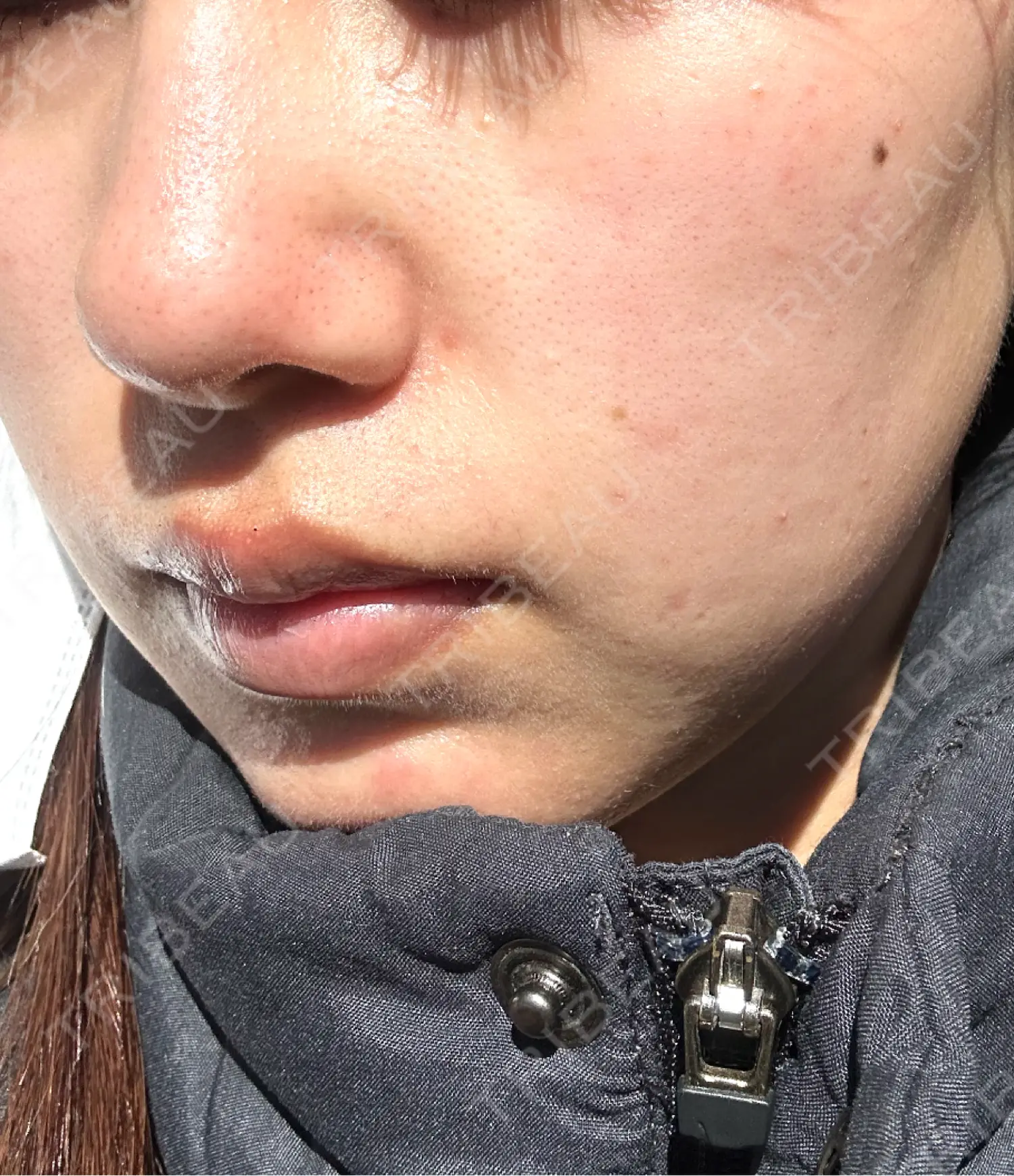 施術前の写真