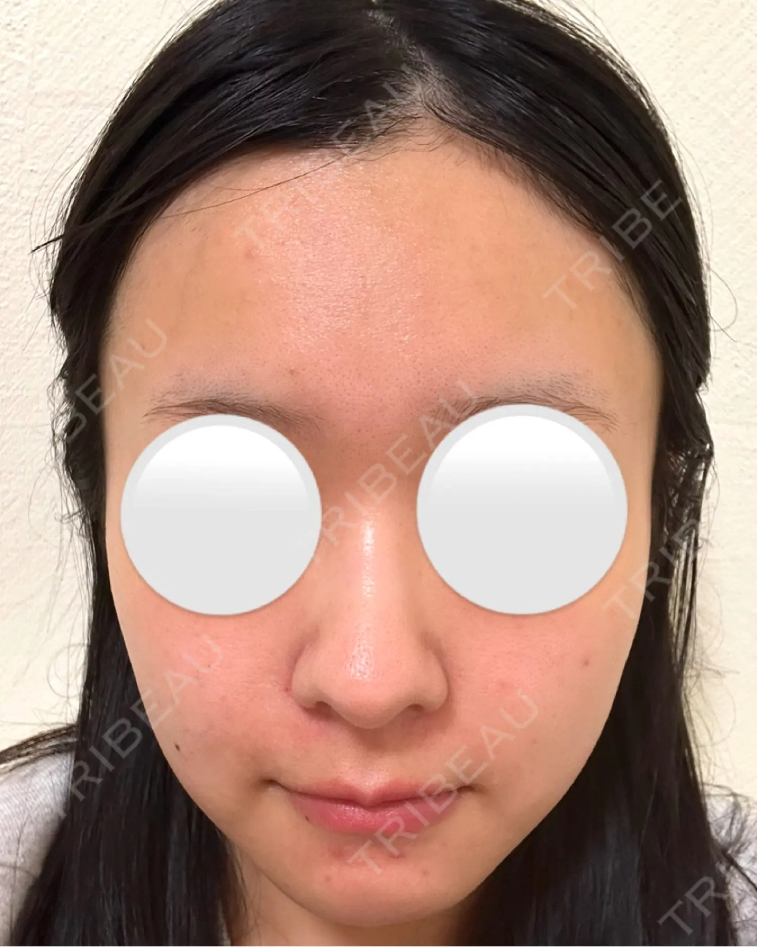 施術前の写真