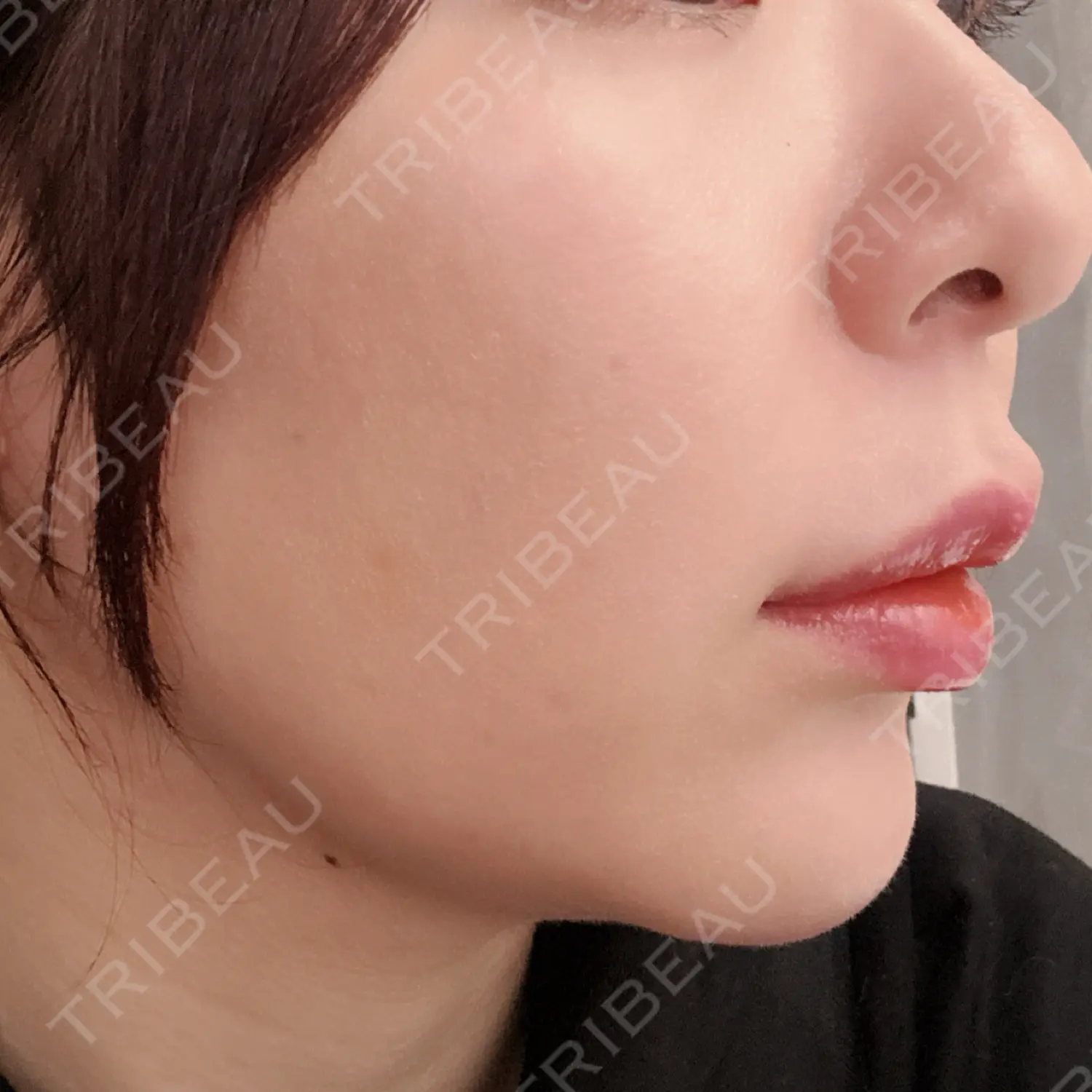 施術前の写真