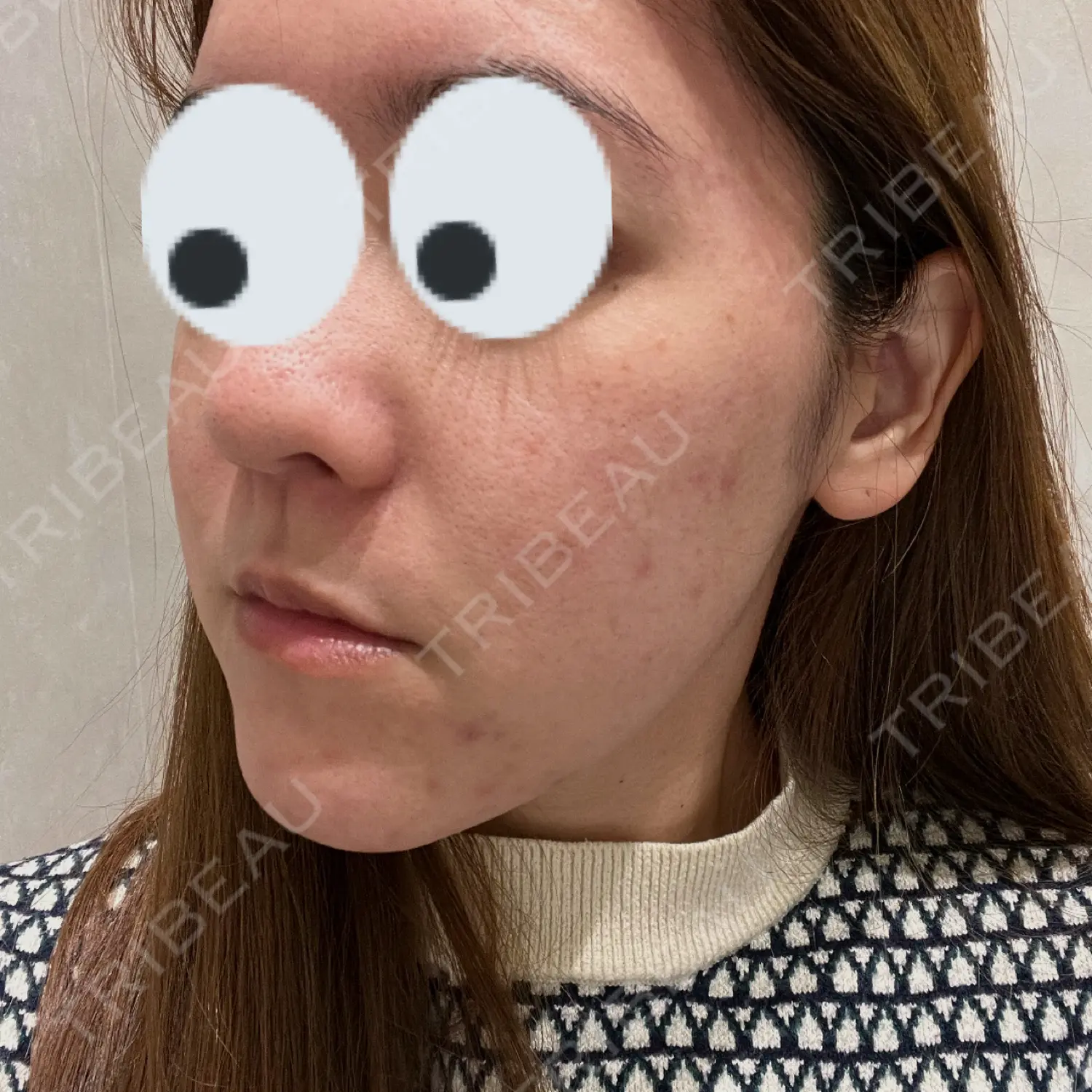 施術前の写真