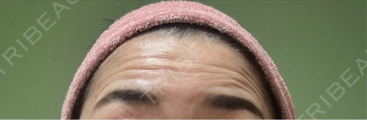 施術前の写真