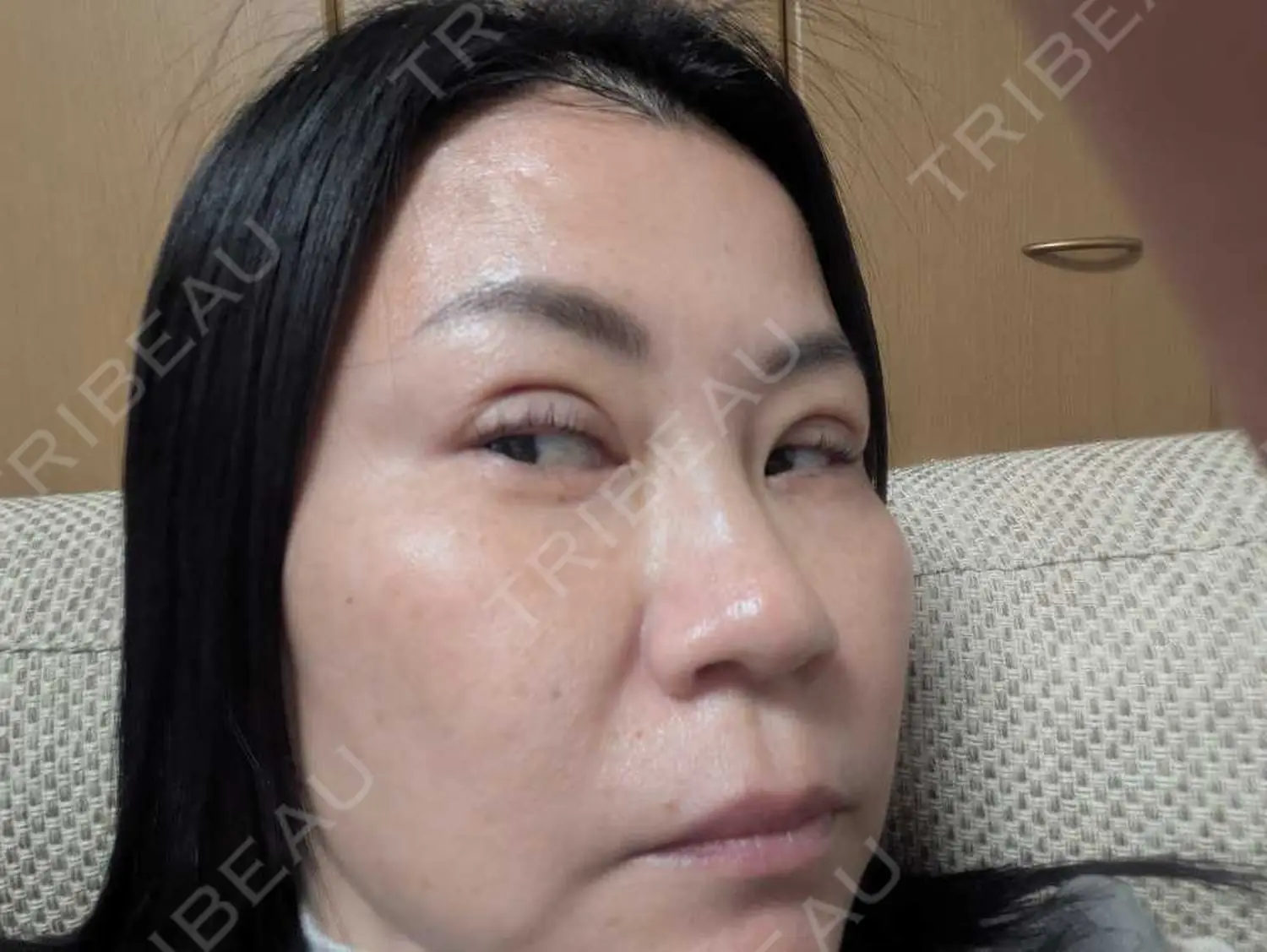 施術前の写真