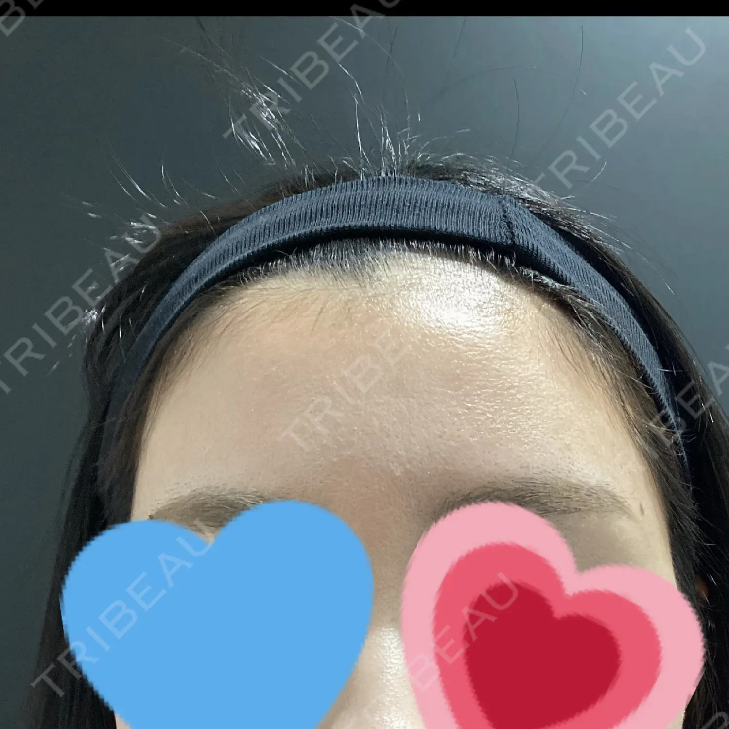 施術前の写真