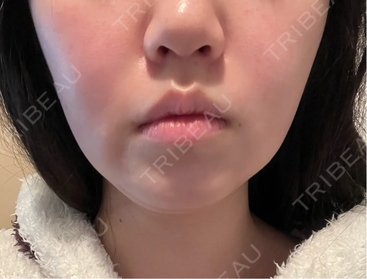施術前の写真