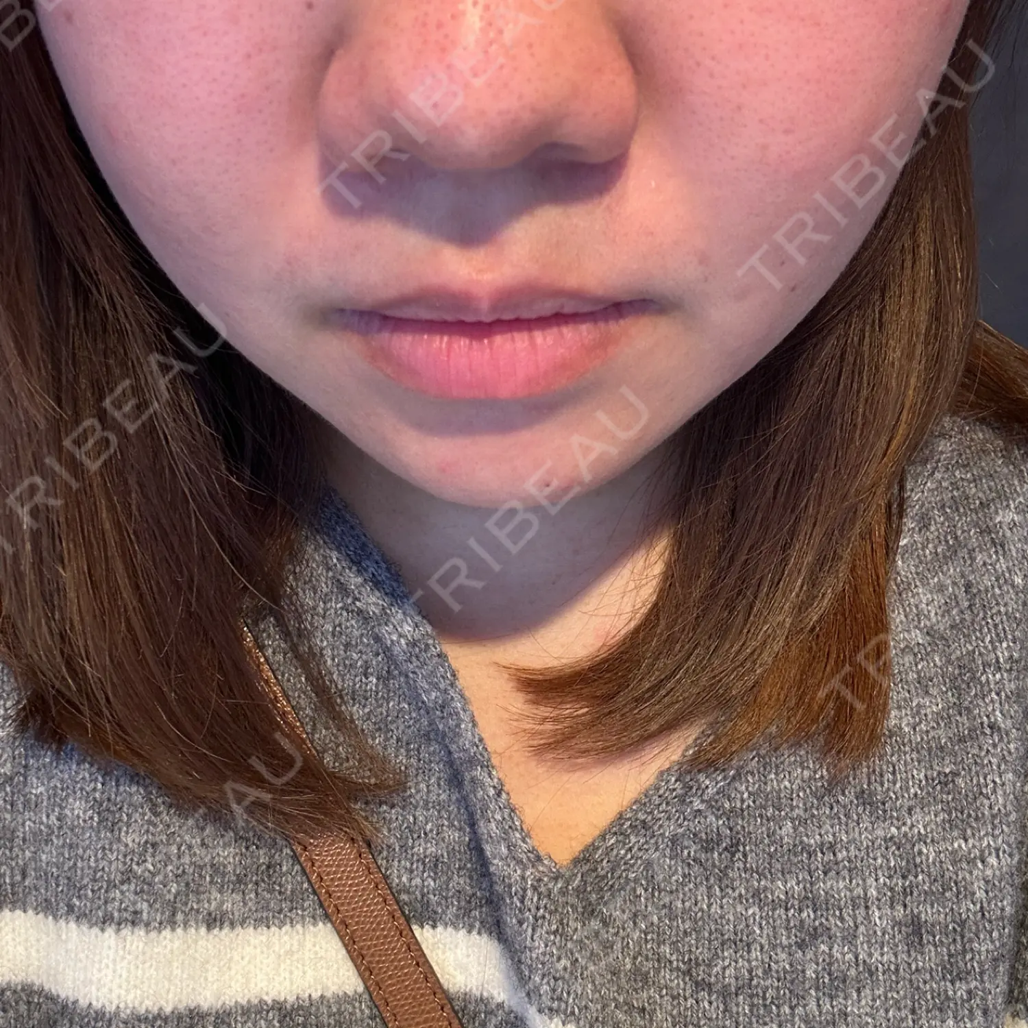 施術前の写真