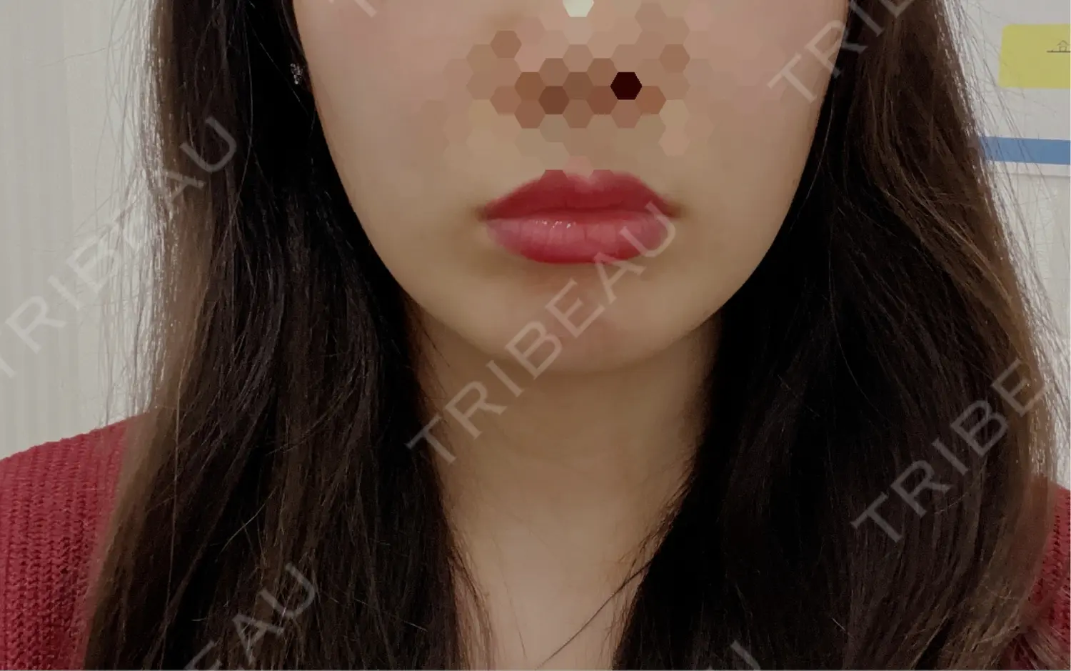 施術前の写真