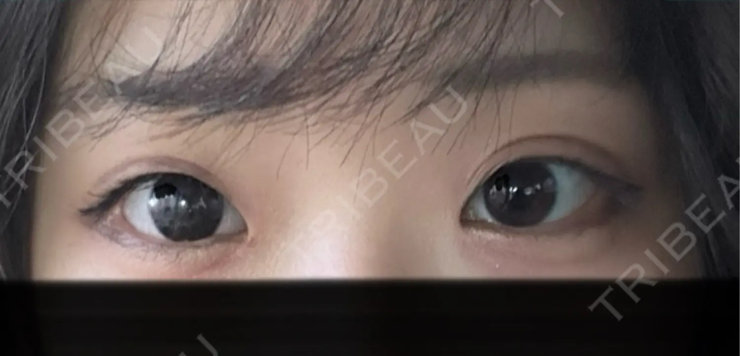 施術前の写真