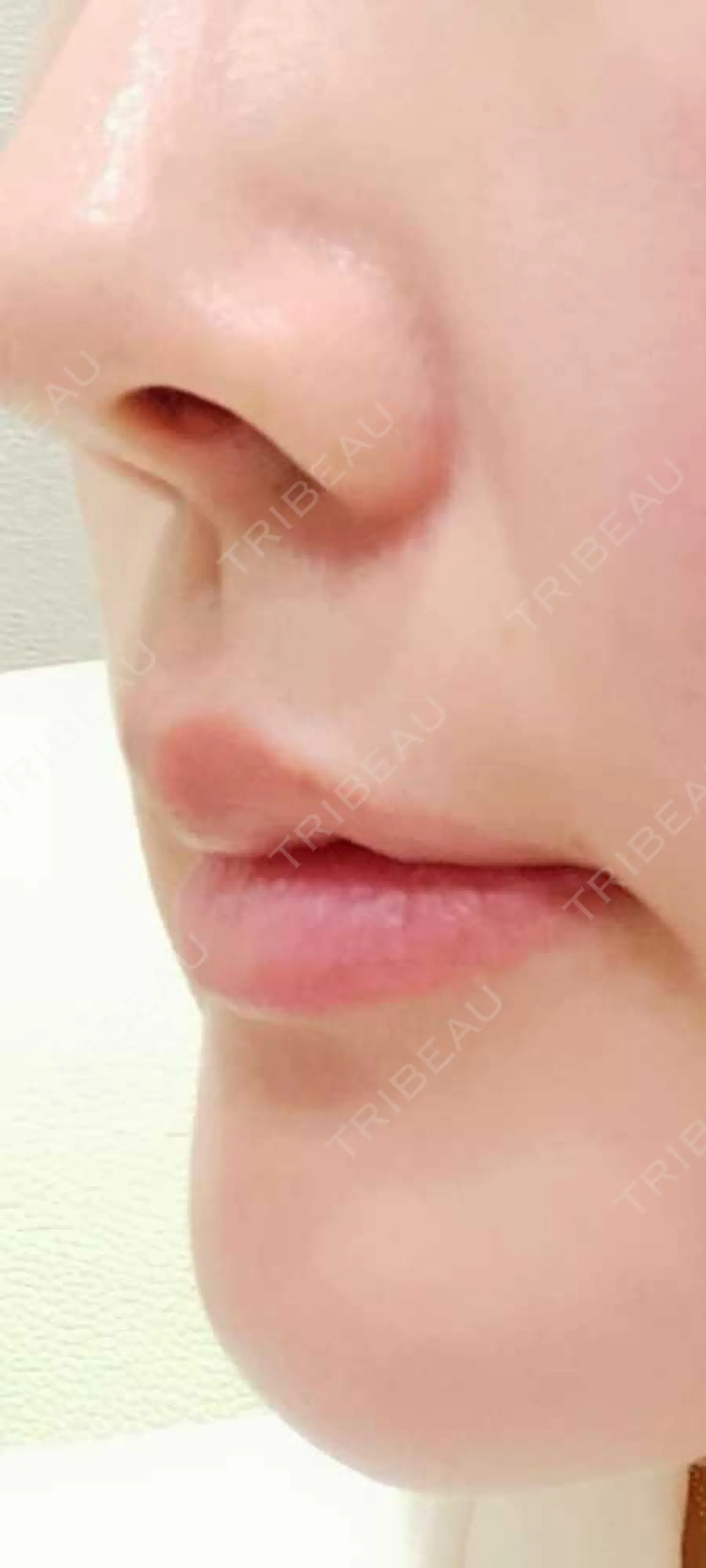 施術前の写真