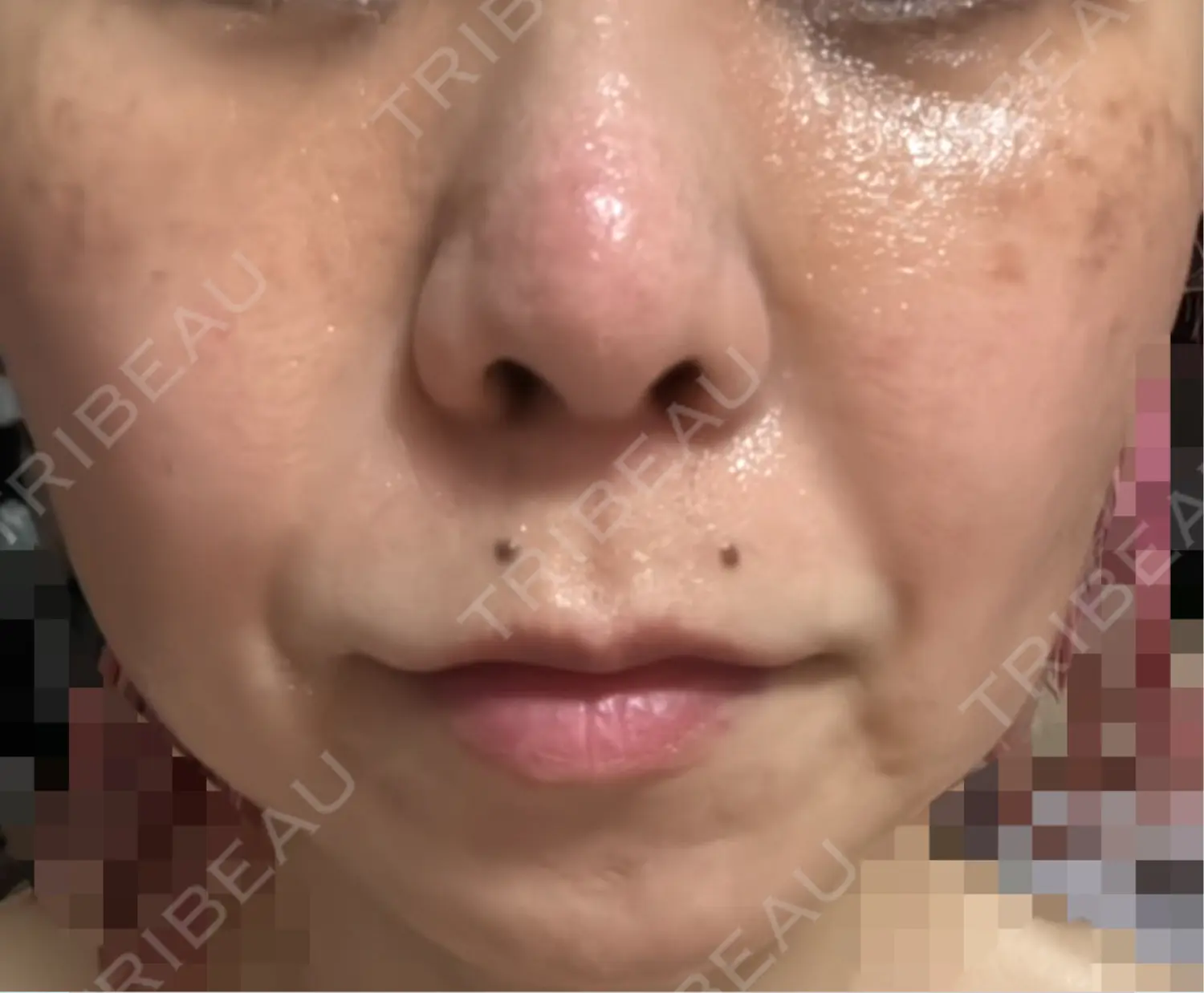 施術前の写真