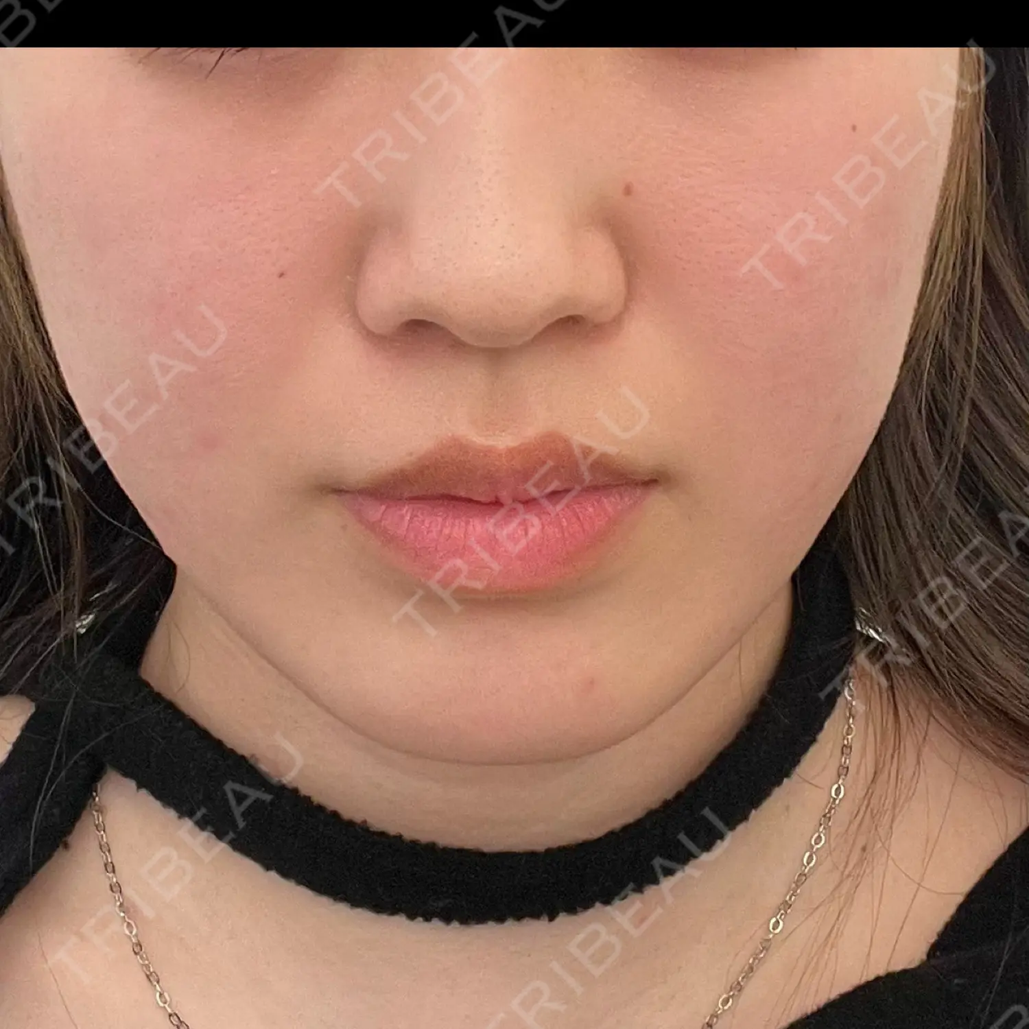 施術前の写真