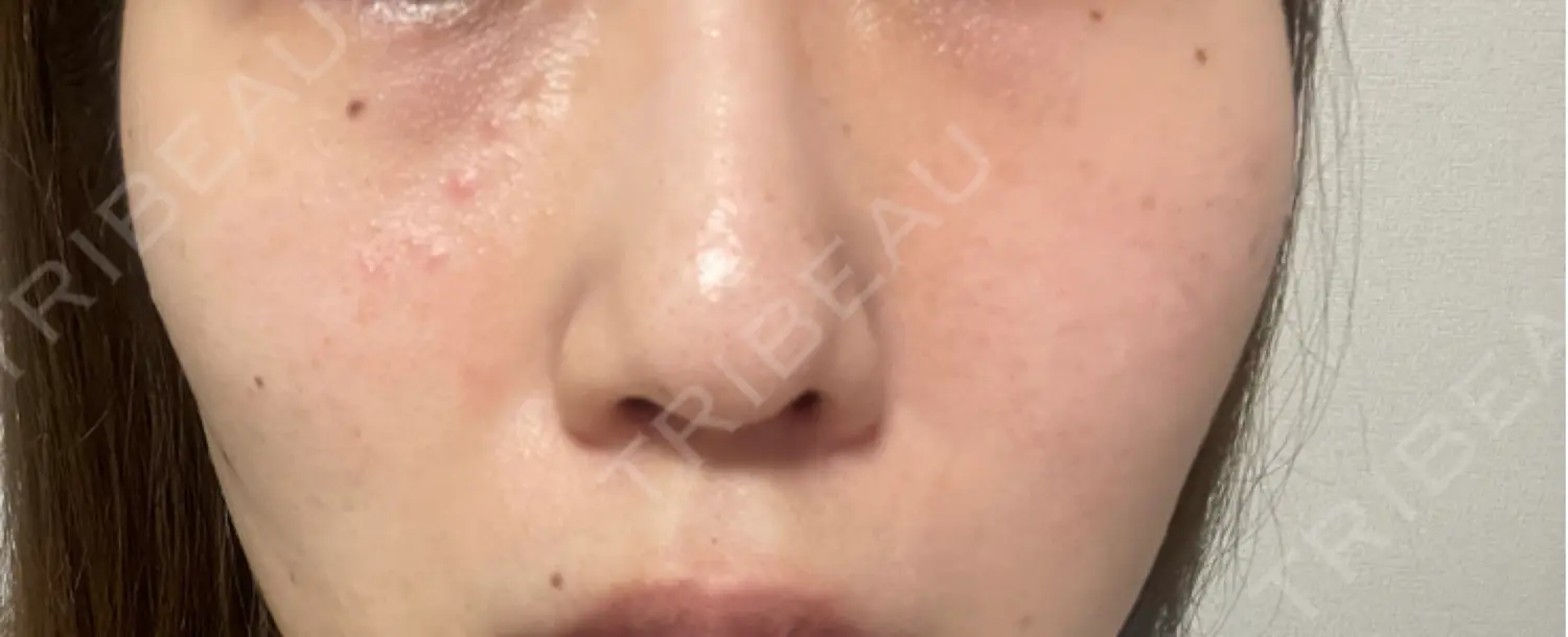 施術前の写真
