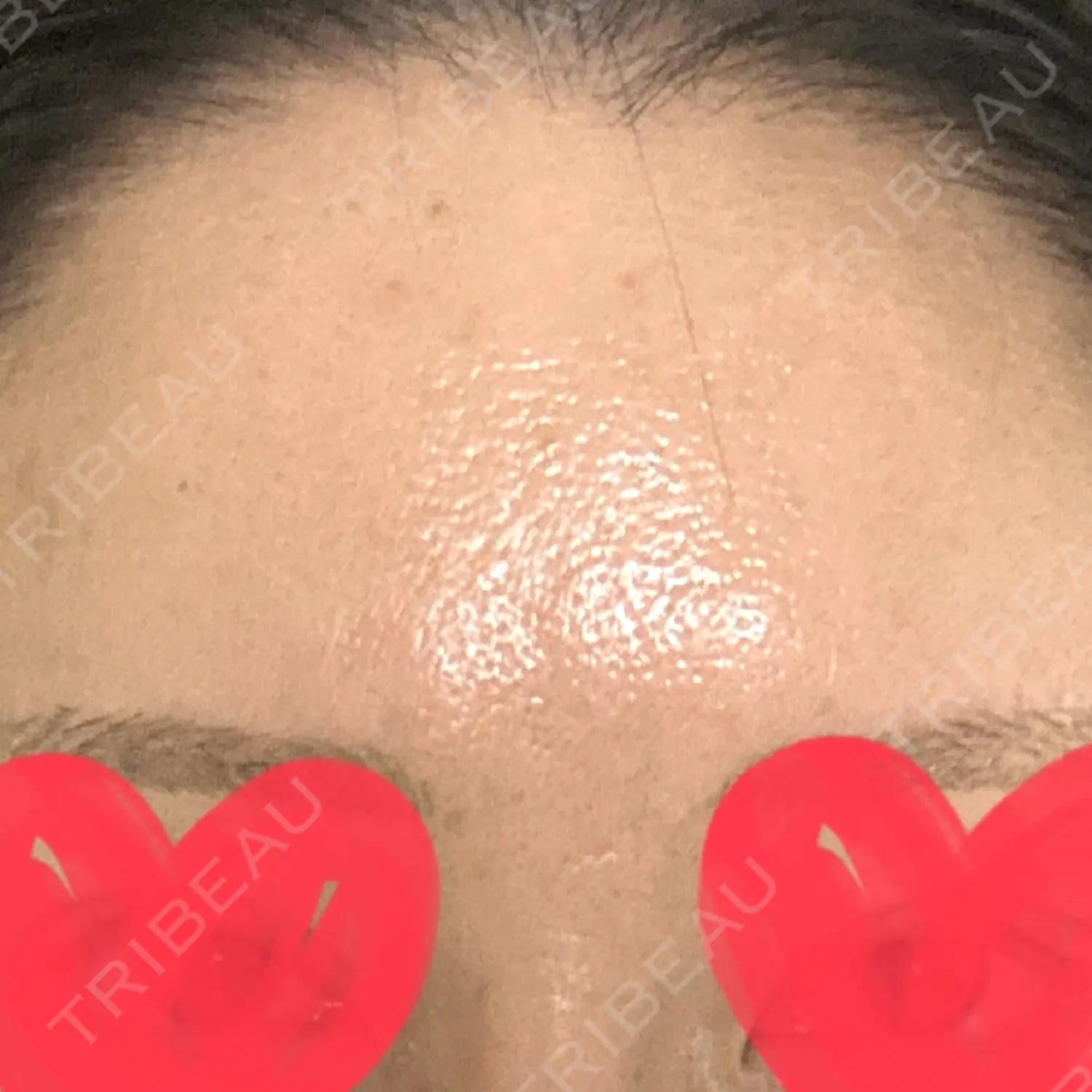 施術前の写真