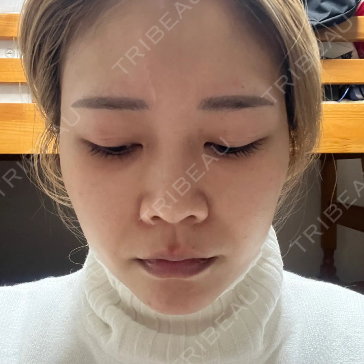 施術前の写真
