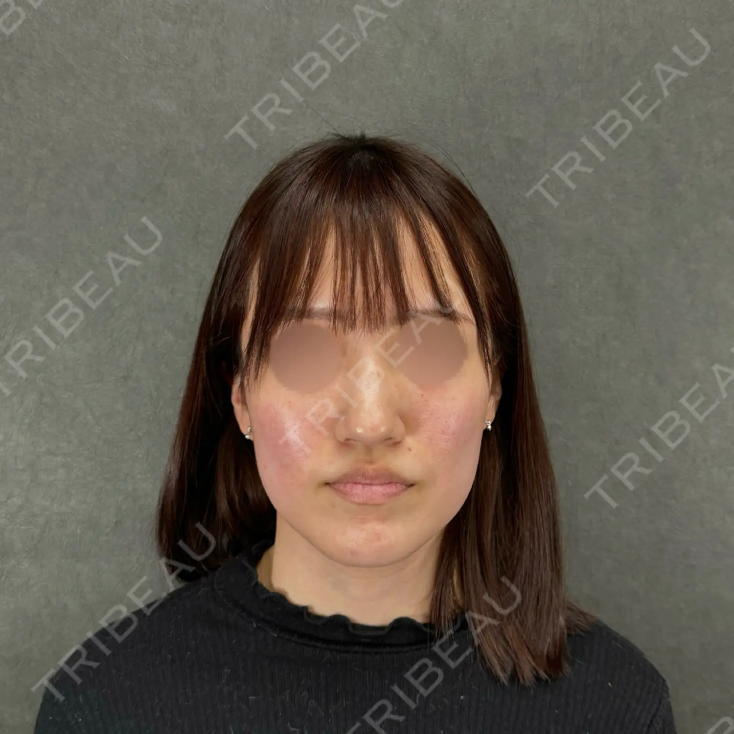 施術前の写真