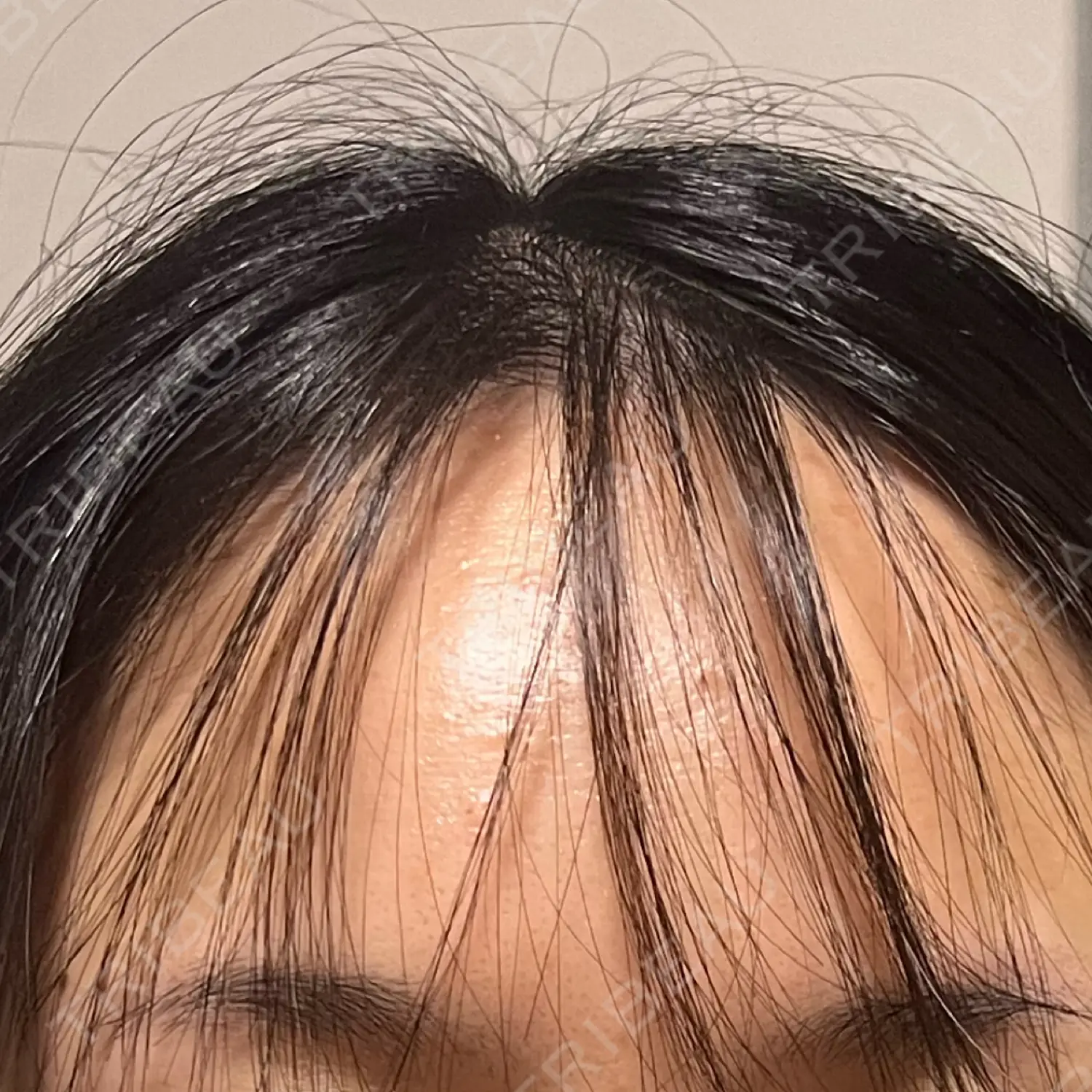 施術前の写真