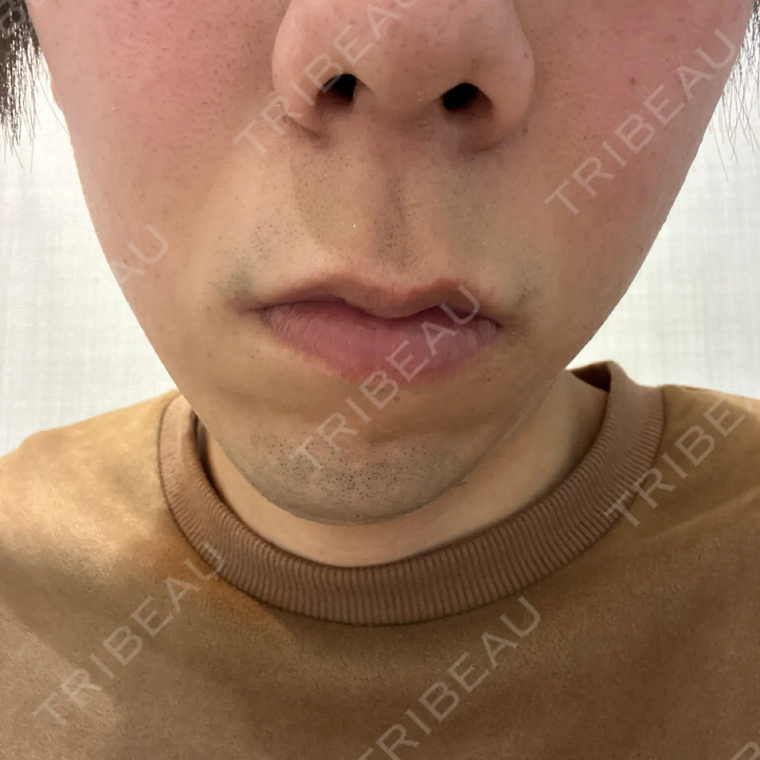 施術前の写真
