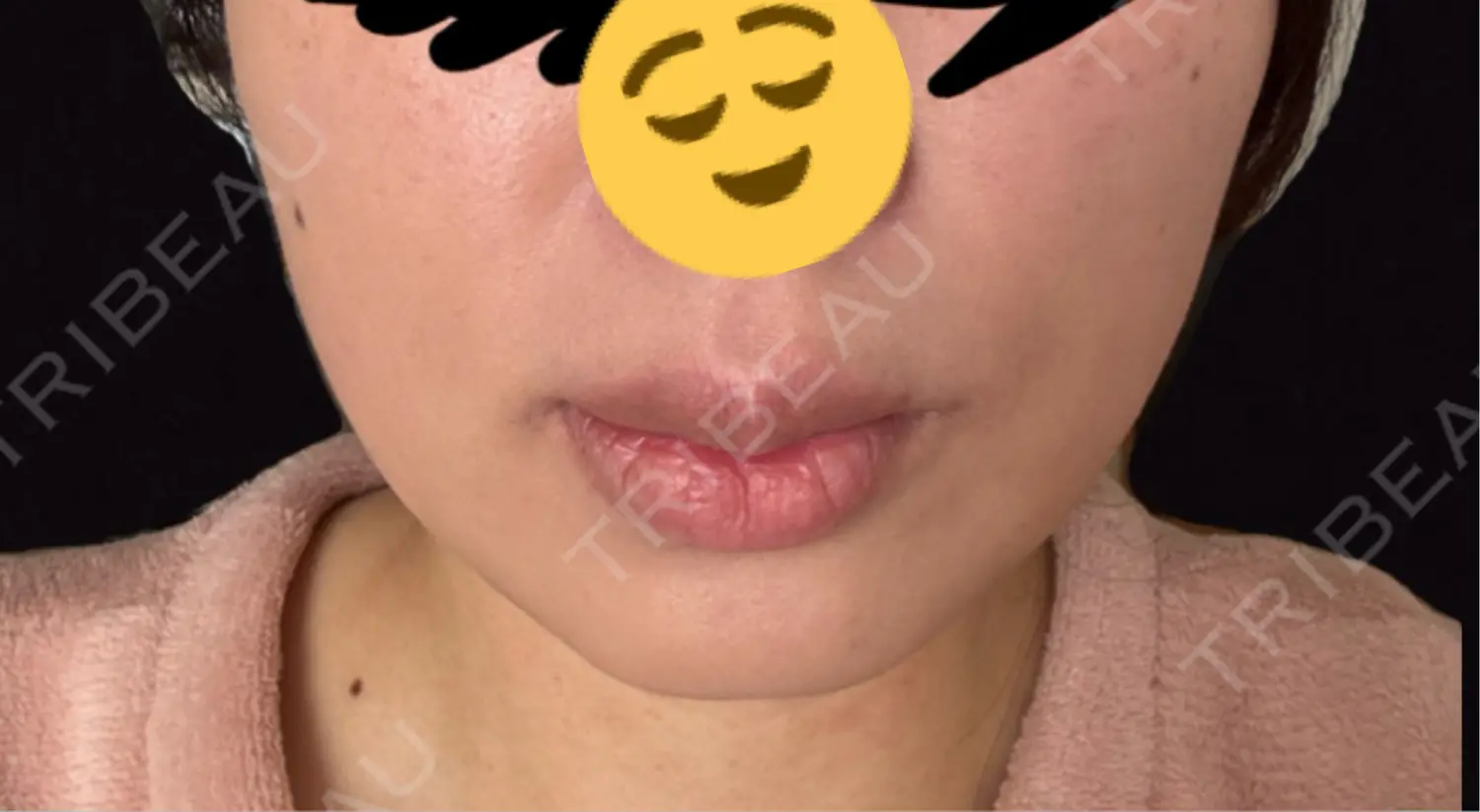 施術前の写真