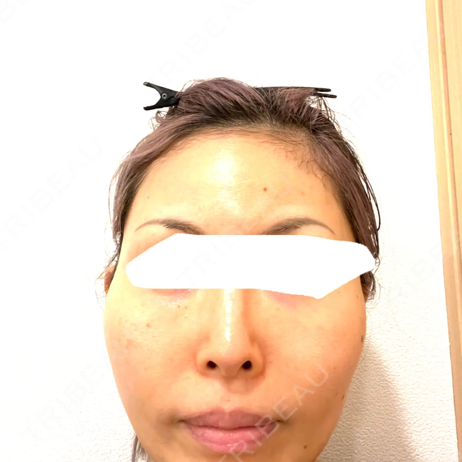 施術前の写真