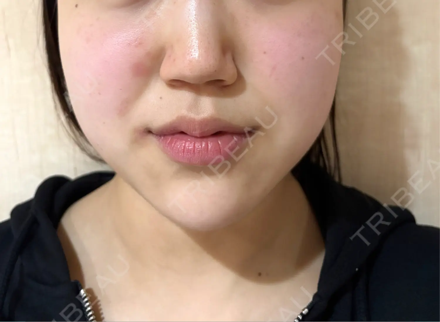 施術前の写真