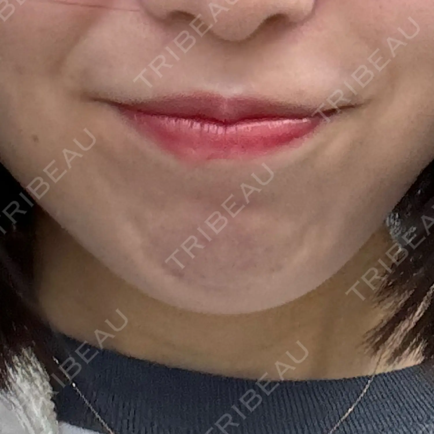 施術前の写真