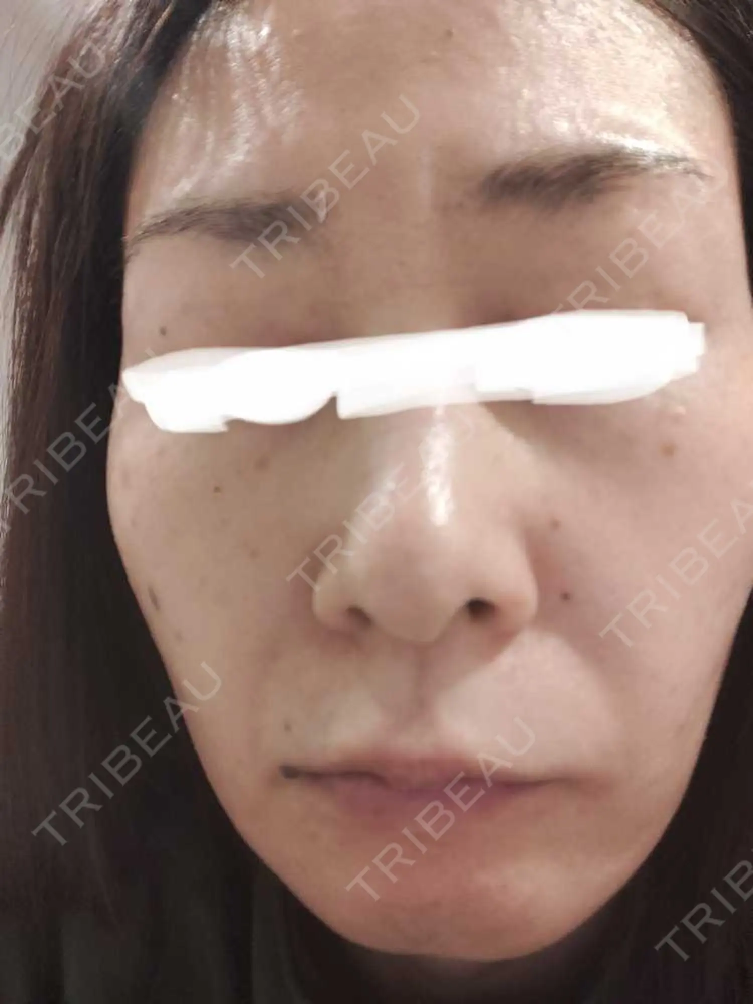 施術前の写真