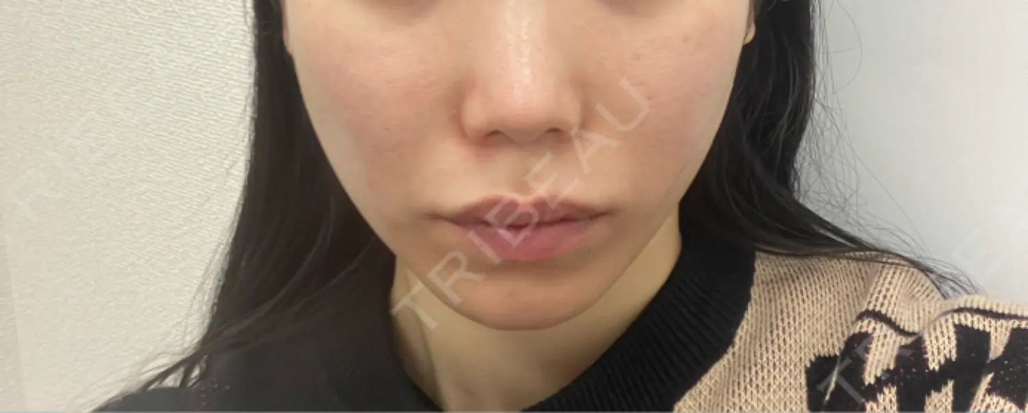 施術前の写真