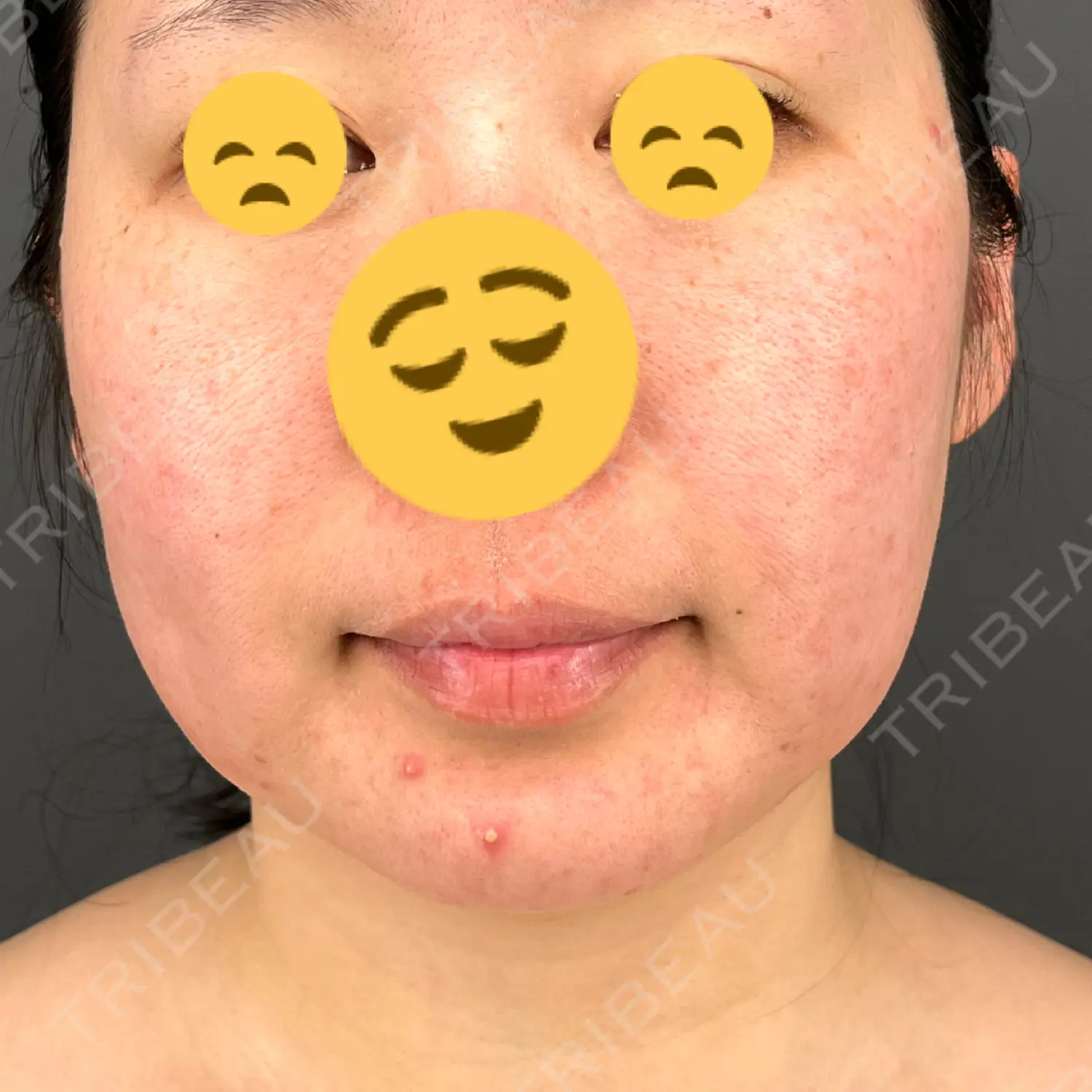 施術前の写真