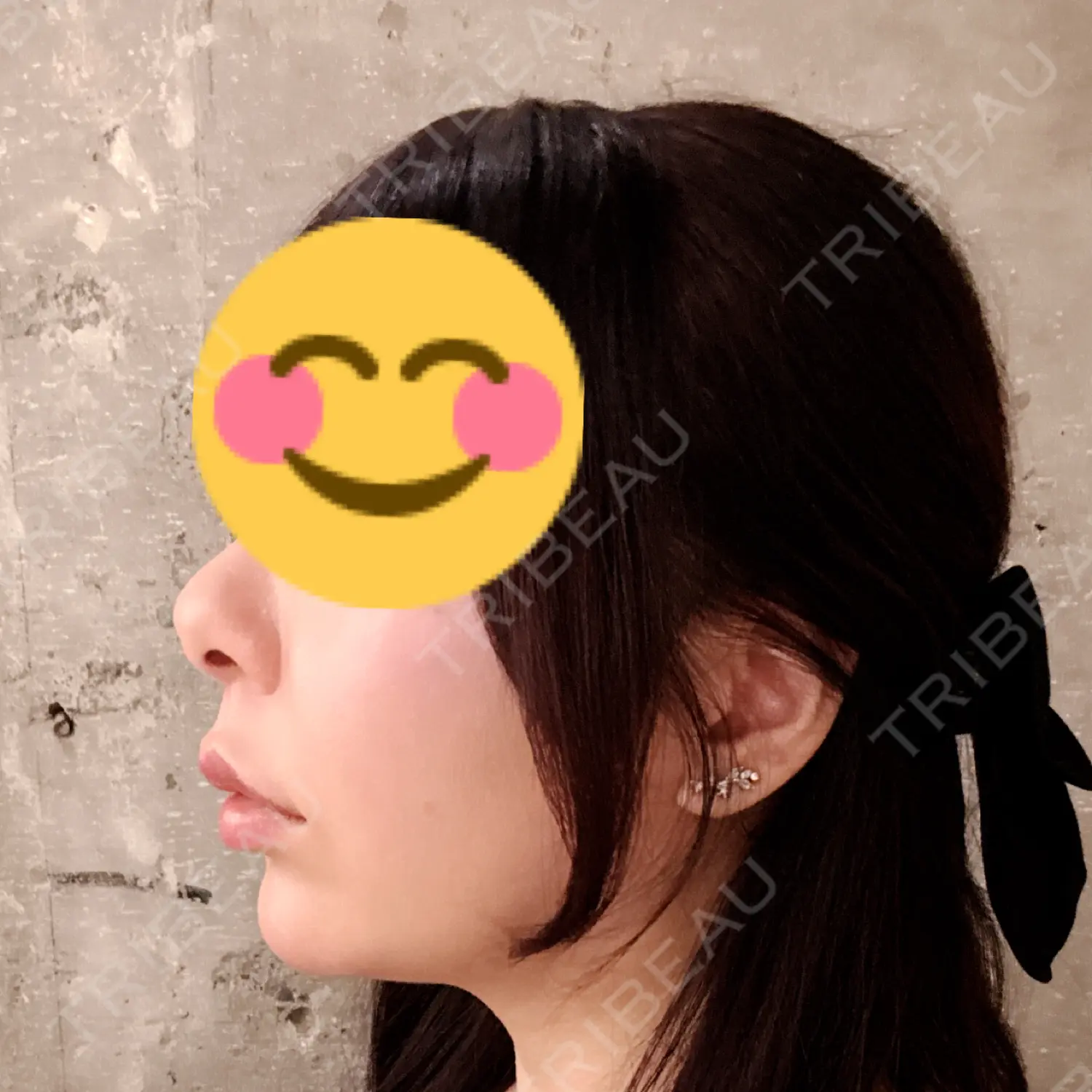 施術前の写真
