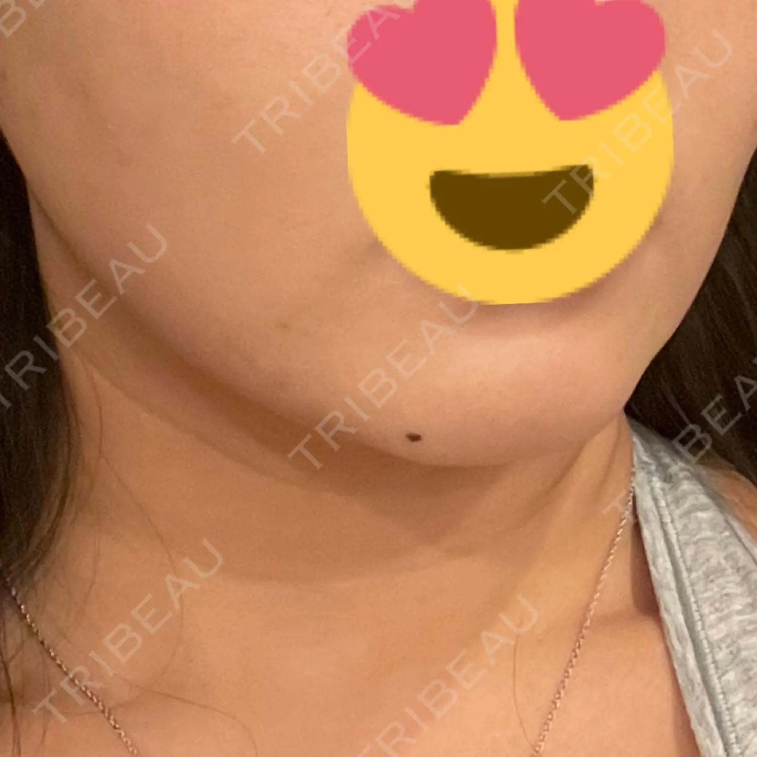 施術前の写真