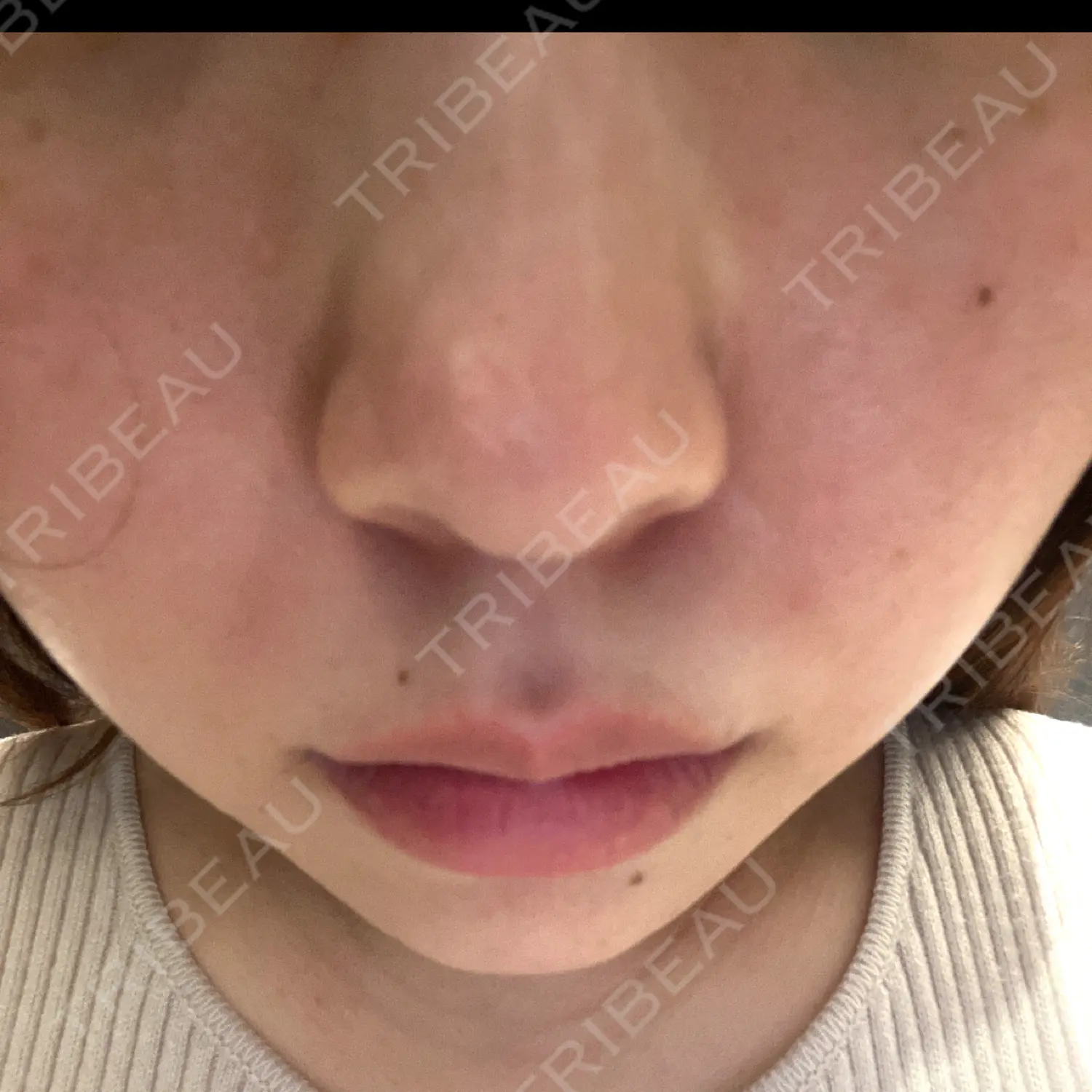 施術前の写真