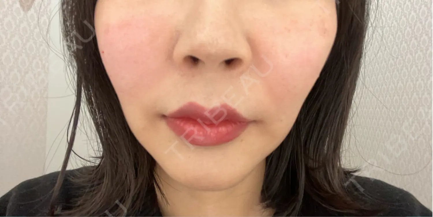 施術前の写真