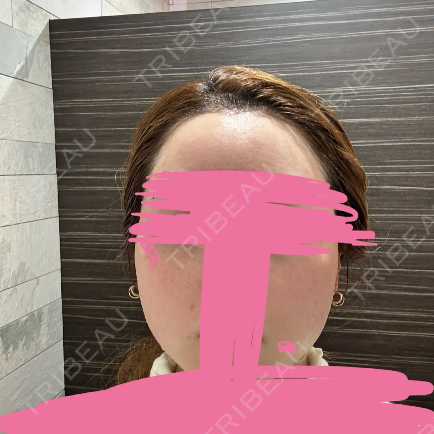 施術前の写真