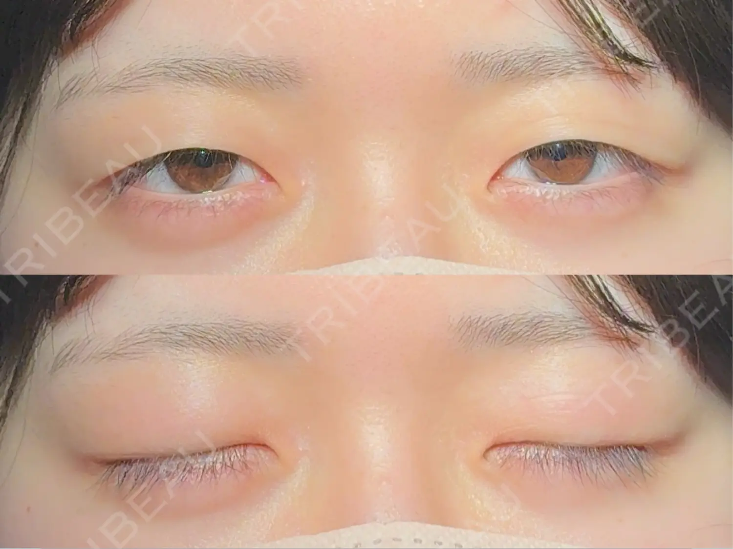 施術前の写真