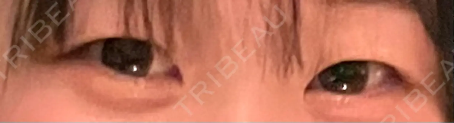 施術前の写真